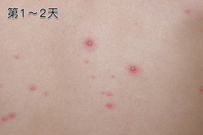 水痘第1-2天图片 水痘第1-2天图片