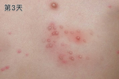 水痘第3天图片 水痘第3天图片