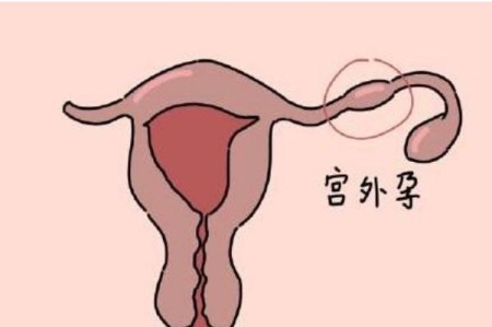 宫外孕试纸能测出来吗 宫外孕hcg值的范围