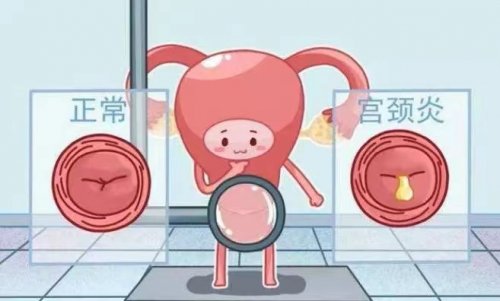 什么是宫颈炎,宫颈炎的发病诱因有哪些