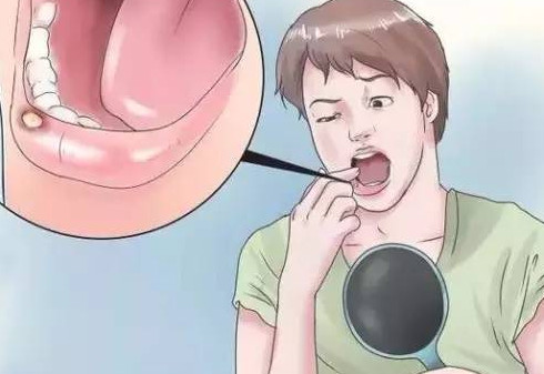 口腔溃疡牙龈肿痛怎么办？口腔溃疡是什么样子