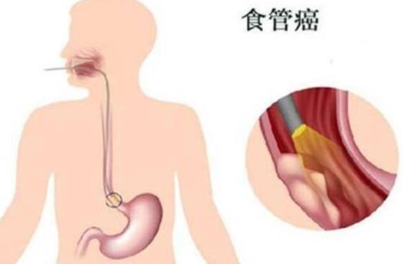 食道癌早期有哪些症状 食道癌早期能治好吗