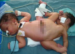 患病几率200万分之一：印尼蜘蛛连体双胞胎成功切除第3条腿